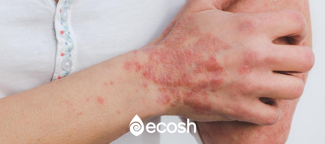 Donna che soffre di psoriasi